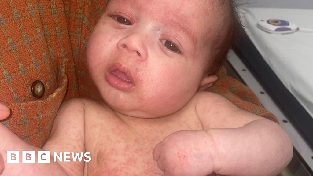 Parents warned of back-to-school measles surge