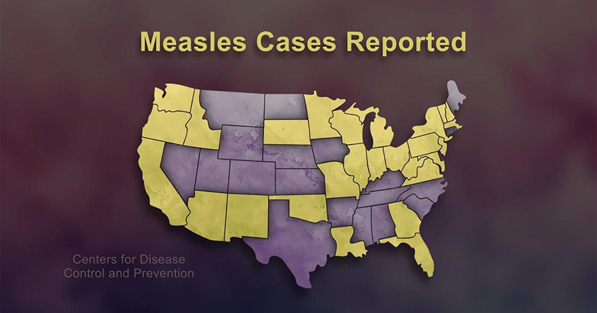 As measles cases increase, experts warn against vaccine skepticism