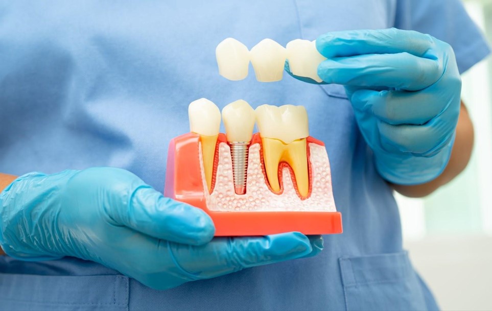 Dental Bridge vs. Dental Implants: Which is Ideal For You?