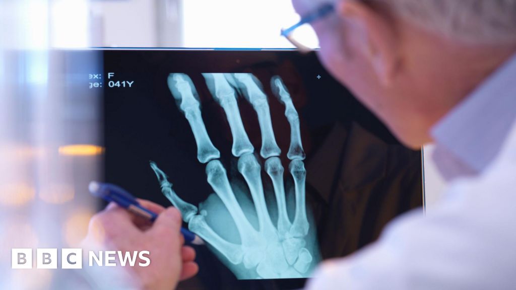 AI to help doctors detect broken bones on X-rays