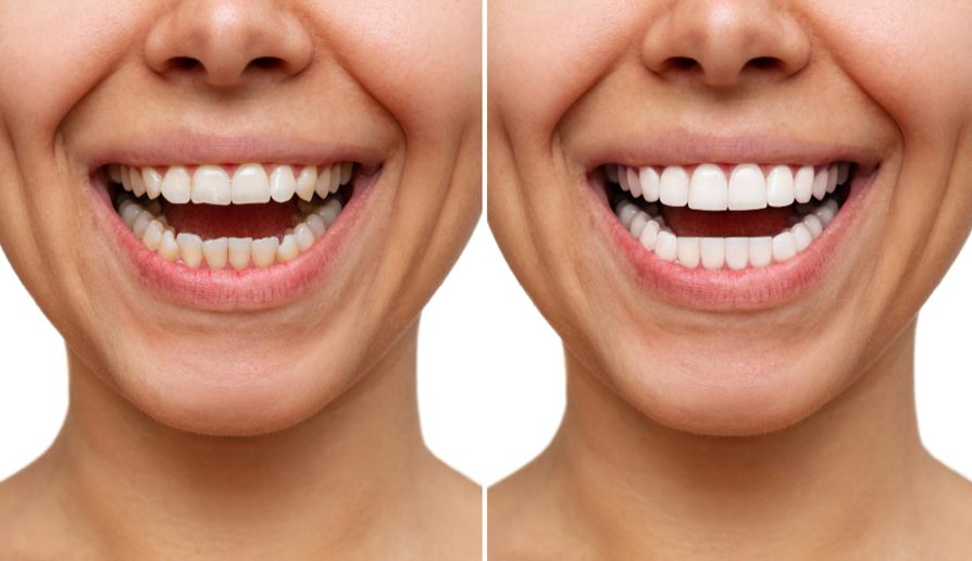 Comprehensive Teeth Cleaning in Miami: Promote Optimal Oral Health and a Brighter Smile