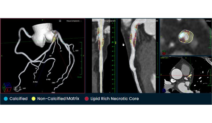 Elucid announces favourable Medicare coverage of AI coronary plaque analysis