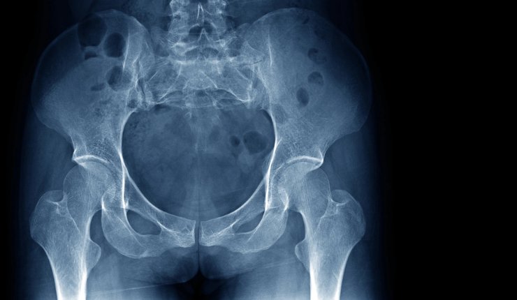 Naitive and Parvizi Surgical Innovation partner to advance osteoporosis detection